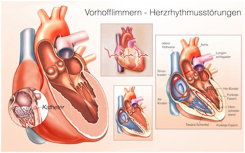 Herzrhythmusstoerungen. Reizleitungssystem.Vorhofflimmern